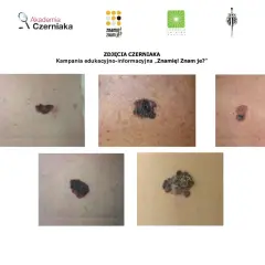 Różne zmiany skórne, od zwykłego pieprzyka po podejrzany czerniak. Kampania "Znamię! Znam je?" uczy rozpoznawać groźne zmiany.