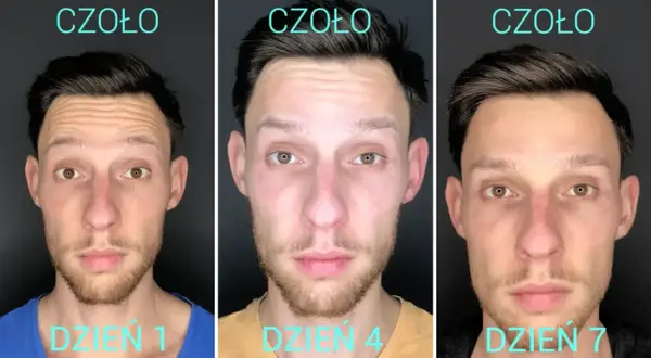 Ewolucja czoła po zabiegu: dzień 1, 4 i 7. Widać wyraźne wygładzenie zmarszczek, co jest efektem zalecenia po botoksie.