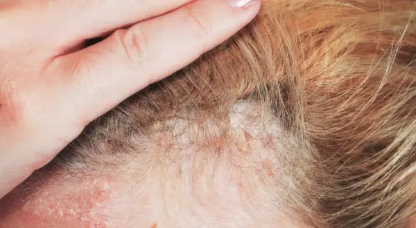 Dłoń dotyka głowy z widocznymi, niegojącymi się strupkami na skórze, które mogą być objawem problemów dermatologicznych.