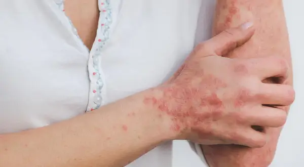Skóra dłoni i przedramienia pokryta łuszczącymi się, czerwonymi zmianami, wskazującymi na choroby autoimmunologiczne skóry.